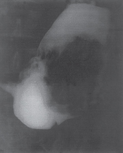 Рентгенограмма желудка.