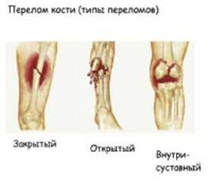 Травмы костей и суставов первая помощь сообщение эндопротезирование тазобедренных суставов им пирогова